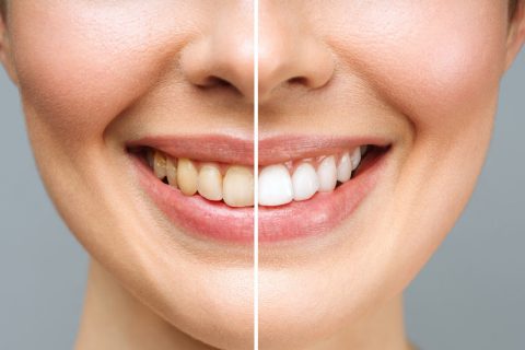 Dental hygiene and whitening