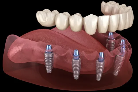 Implantes Dentales