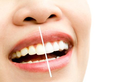 Profilaxis y Blanqueamiento dental