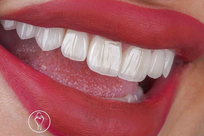 Carillas Dentales: Una Solución Estética para Tu Sonrisa