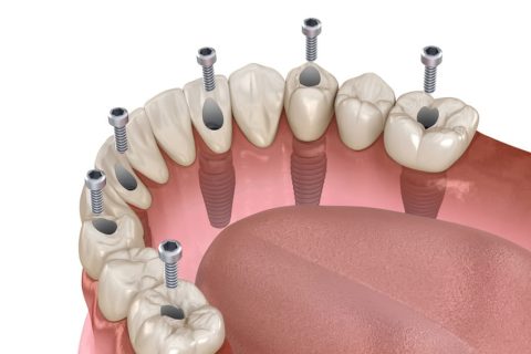 Implantes Dentales