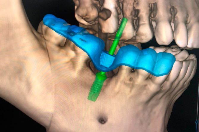 Cirugía de Implantes Dentales con Guía Quirúrgica: Precisión y Seguridad para el Paciente