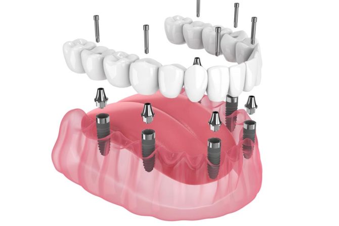 ¿Necesitas implantes dentales? 