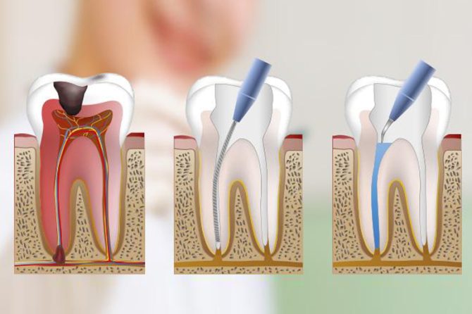 ¿Cuándo es necesario hacer una endodoncia? 5 señales a las que debes prestar atención