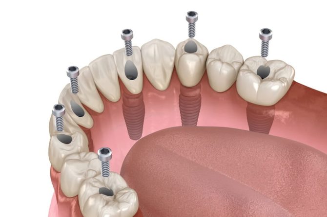 dental implants